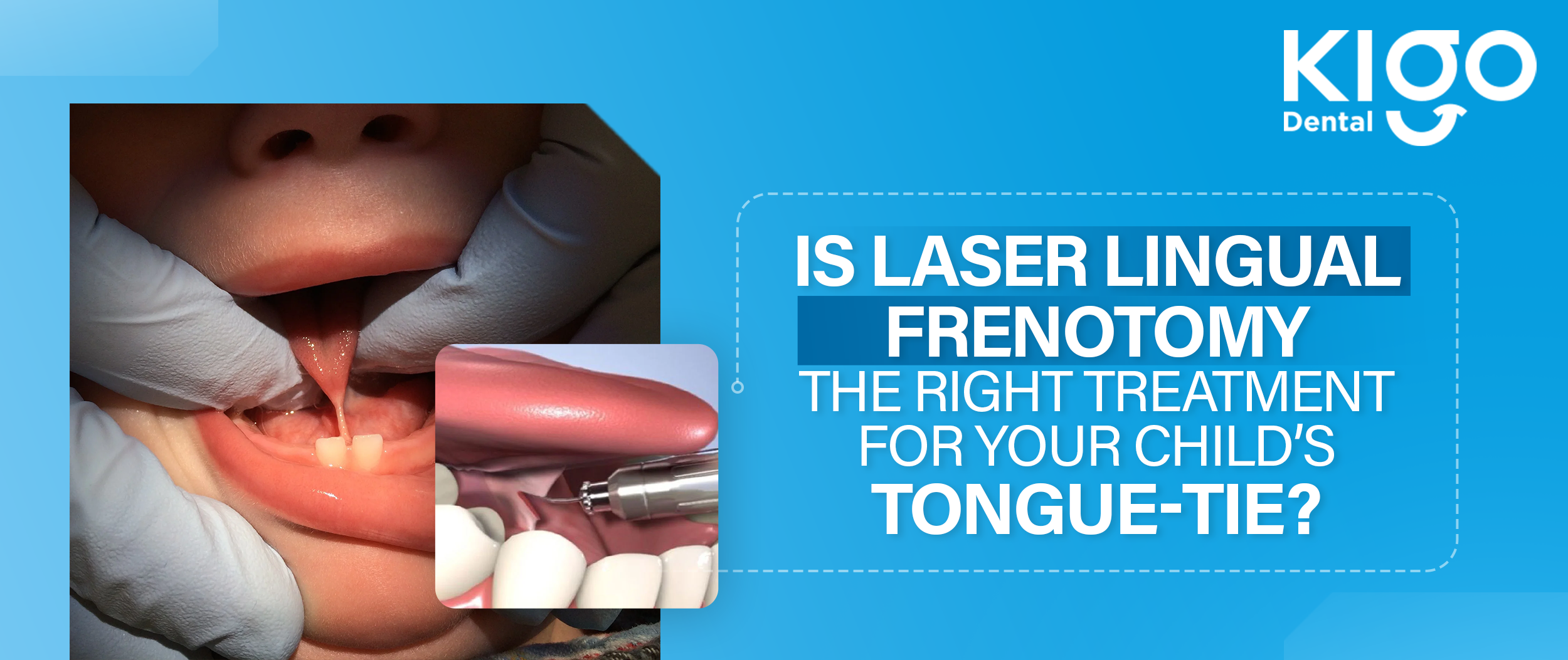 Is Laser Lingual Frenotomy the Right Treatment for Your Child’s Tongue-Tie