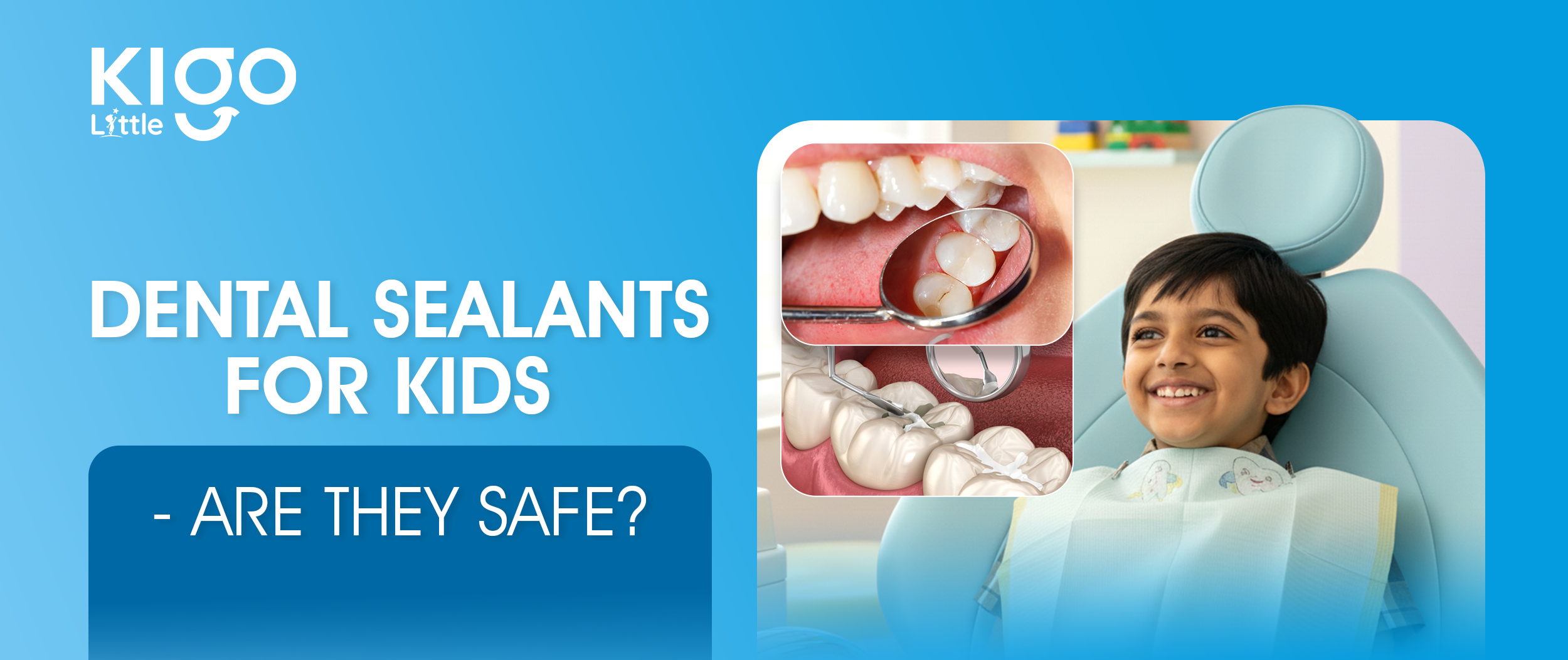 dental sealants for kids